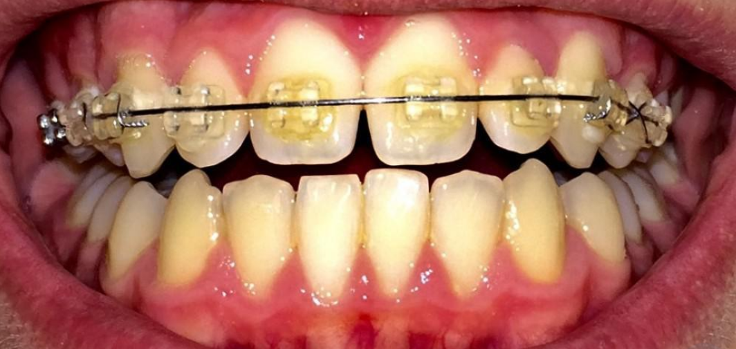 Clear on sale braces elastics